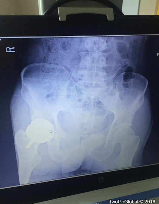 Bionic right hip