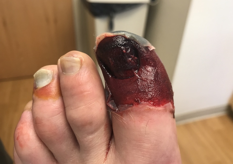 Toe0603